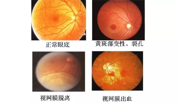 沪深策略联盟 眼底一张照，眼病早知道！合肥普瑞眼科：这几类人要定期检查_大皖新闻 | 安徽网